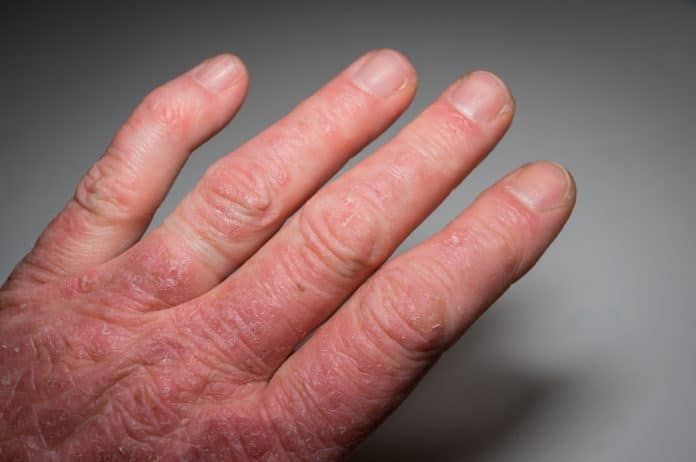 Joint or rheumatism psoriasis that: What is it’is health mission