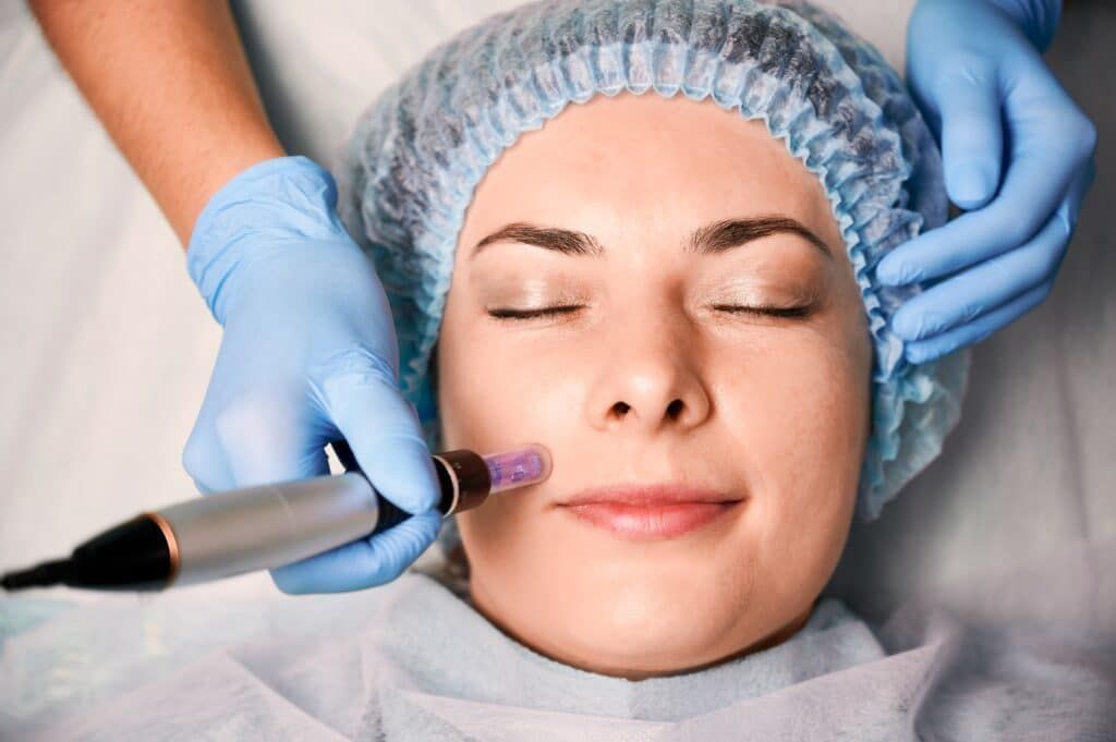What does microneedling?